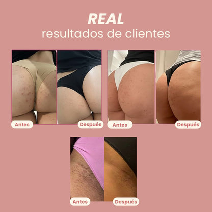 Kit gluttea® – Dúo Antimanchas & Anti‑acné para Glúteos